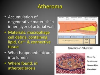 Atheroma
• Accumulation of
degenerative materials in
inner layer of arterial wall
• Materials: macrophage
cell debris, containing
lipid, Ca++ & connective
tissue
• What happened: intrude
into lumen
• Where found: in
atherosclerosis
 