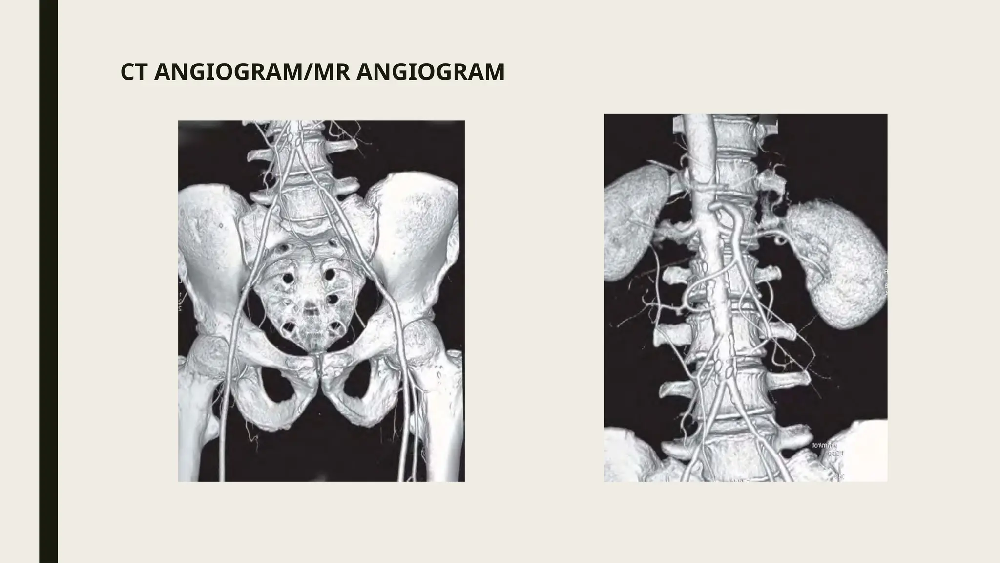 CT ANGIOGRAM/MR ANGIOGRAM
 