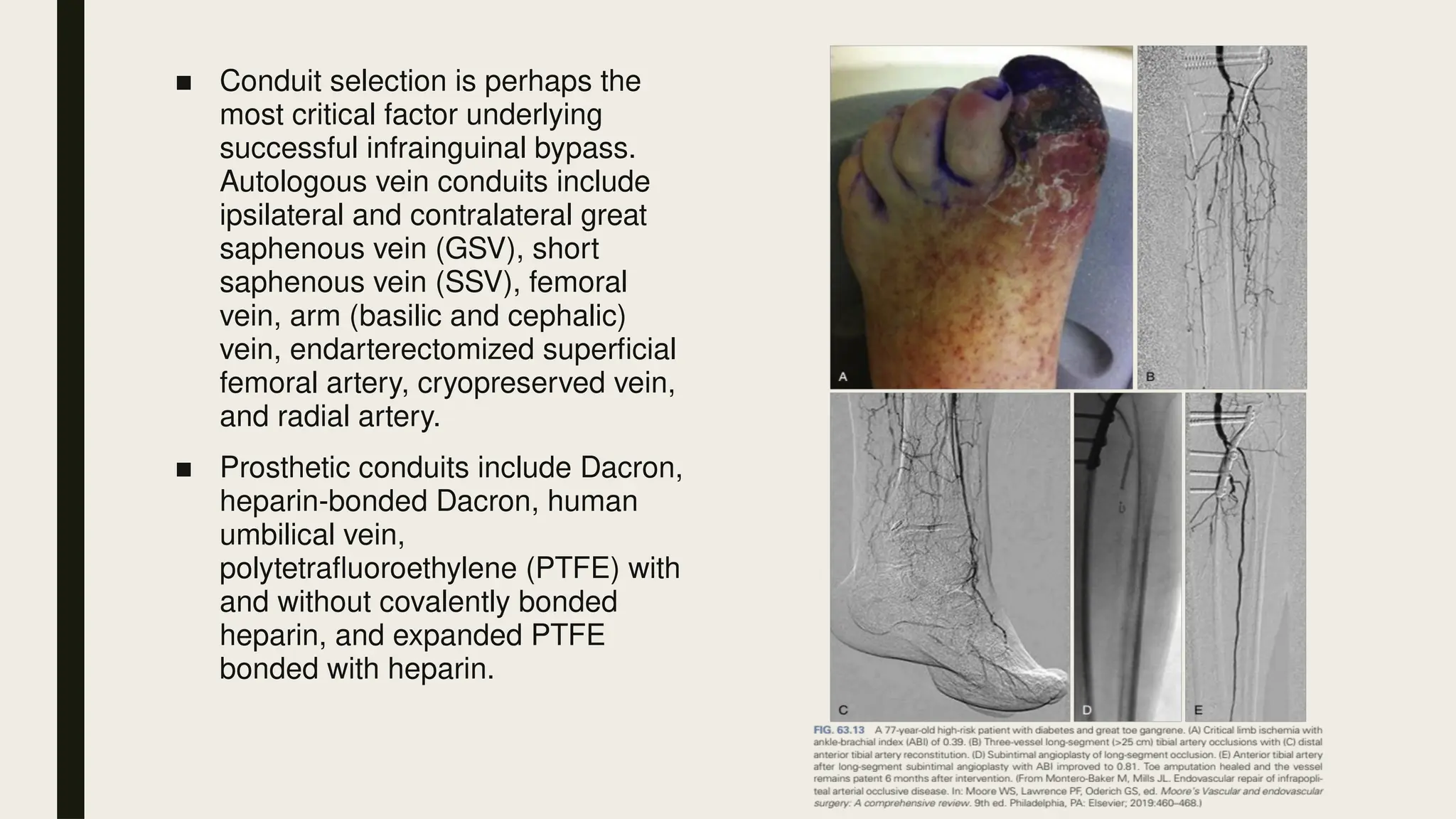 ■ Conduit selection is perhaps the
most critical factor underlying
successful infrainguinal bypass.
Autologous vein conduits include
ipsilateral and contralateral great
saphenous vein (GSV), short
saphenous vein (SSV), femoral
vein, arm (basilic and cephalic)
vein, endarterectomized superficial
femoral artery, cryopreserved vein,
and radial artery.
■ Prosthetic conduits include Dacron,
heparin-bonded Dacron, human
umbilical vein,
polytetrafluoroethylene (PTFE) with
and without covalently bonded
heparin, and expanded PTFE
bonded with heparin.
 