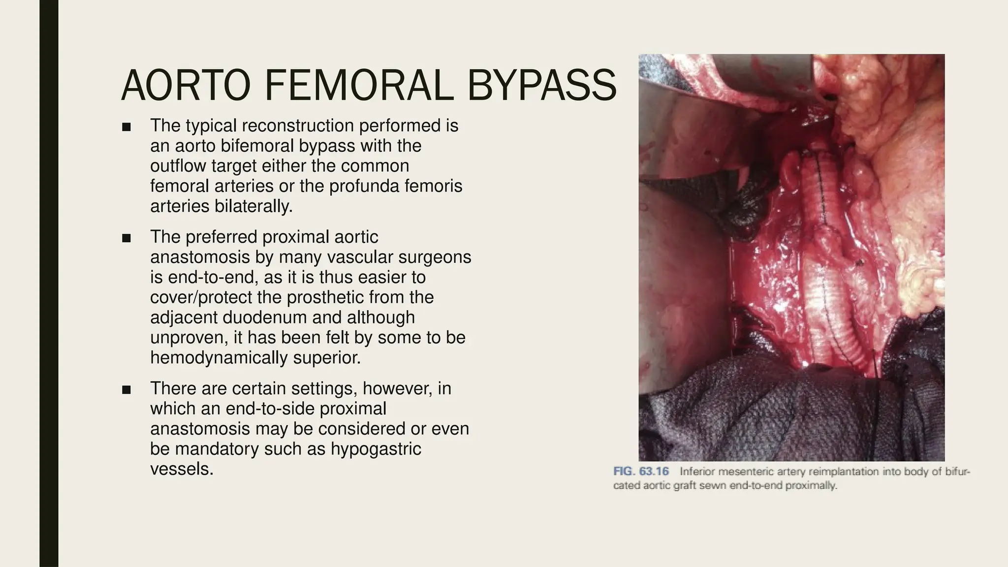 AORTO FEMORAL BYPASS
■ The typical reconstruction performed is
an aorto bifemoral bypass with the
outflow target either the common
femoral arteries or the profunda femoris
arteries bilaterally.
■ The preferred proximal aortic
anastomosis by many vascular surgeons
is end-to-end, as it is thus easier to
cover/protect the prosthetic from the
adjacent duodenum and although
unproven, it has been felt by some to be
hemodynamically superior.
■ There are certain settings, however, in
which an end-to-side proximal
anastomosis may be considered or even
be mandatory such as hypogastric
vessels.
 