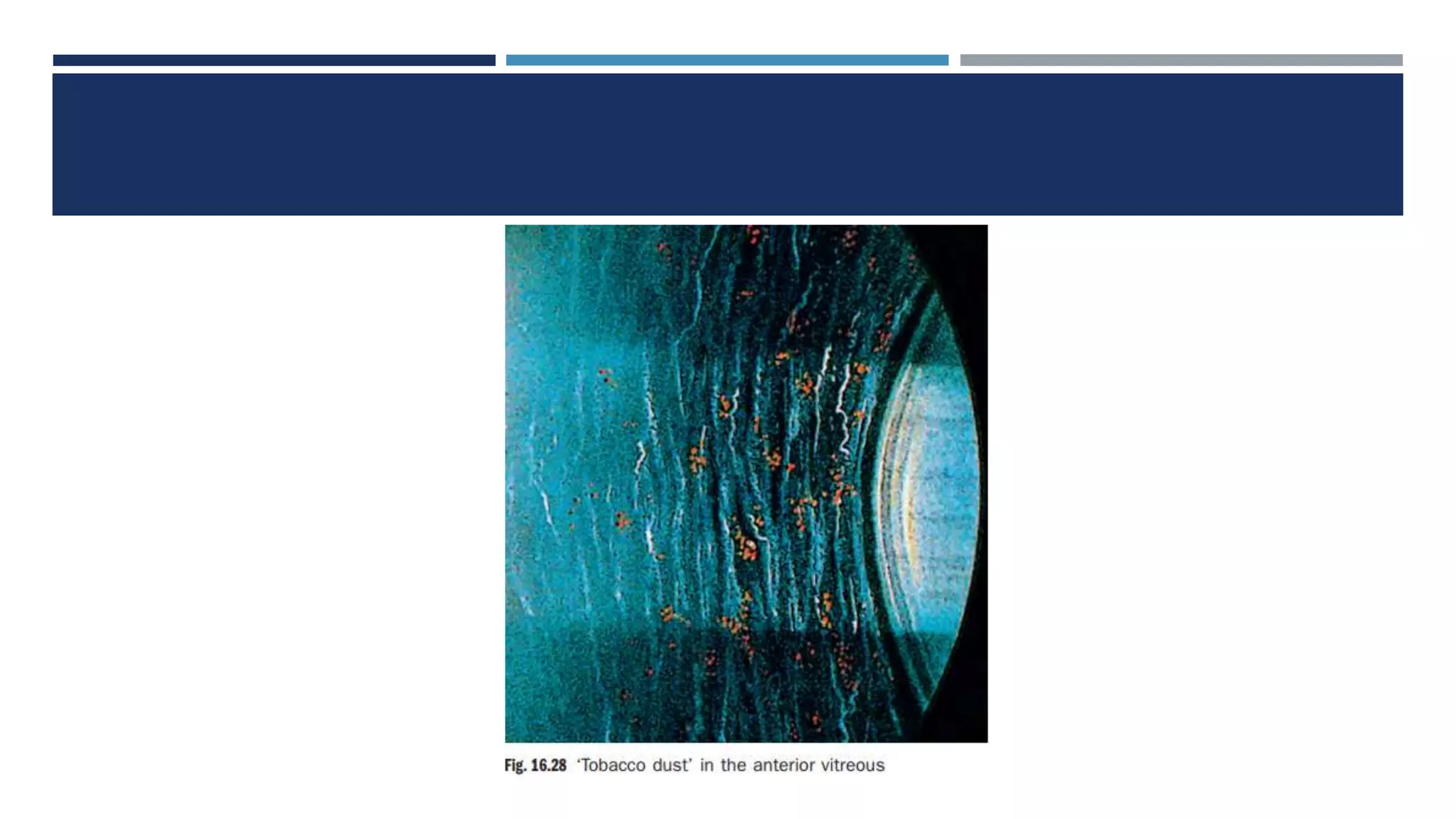 tobacco dust in anterior vitreous 0081: Schaffer's sign The Shaffer sign, also known