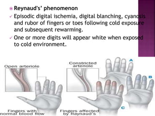  Reynaud's’ phenomenon
 Episodic digital ischemia, digital blanching, cyanosis
and rubor of fingers or toes following cold exposure
and subsequent rewarming.
 One or more digits will appear white when exposed
to cold environment.
 