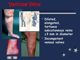 Varicose Veins
 Dilated,
elongated,
tortuous
subcutaneous veins
≥3 mm in diameter
 Incompetent
venous valves
 
