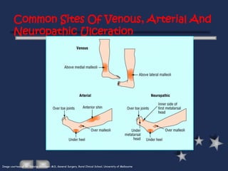 Common Sites Of Venous, Arterial And
Neuropathic Ulceration
Image courtesy of Mr. Nikolas Kosanovic M.D, General Surgery, Rural Clinical School, University of Melbourne
 