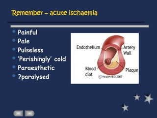 Remember – acute ischaemia
 Painful
 Pale
 Pulseless
 ‘Perishingly’ cold
 Paraesthetic
 ?paralysed
 