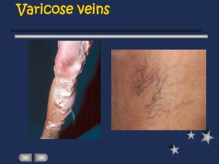 Varicose veins
 
