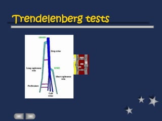 Trendelenberg tests
 