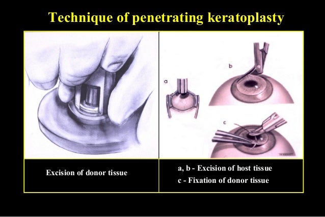 20 Corneal Surgery