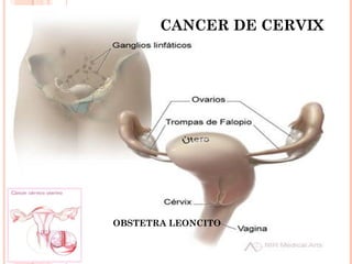 CANCER DE CERVIX
OBSTETRA LEONCITO
 