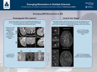 Emerging Biomarkers in Multiple Sclerosis
Full abbreviations, accreditation, and disclosure information available at PeerView.com/JHE40
Emerging MRI Biomarkers in MS
White matter lesions in MS are the result of immune cell infiltration from the
periphery into the CNS via small penetrating veins. These inflammatory
lesions result in oligodendrocyte and myelin damage as well as neuro-axonal
degeneration.
Chronic active lesions in MS can be identified pathologically by an
iron rim at the lesion edge that contains iron-laden macrophages
and microglia as well as activated astrocytes.
Paramagnetic Rim Lesions1
Central Vein Signs2
3T SWI and FLAIR
images showing
examples of rim
lesions in
periventricular
(a, d), juxtacortical
(b, e), and
infratentorial (c, f)
regions
T1 and FLAIR
appearance of an
SWI rim lesion
Axial 3T FLAIR images
showing central vein sign
in the three orthogonal
planes
Axial 1.5T T2 echo-planar
images in the three orthogonal
planes for central vein assessment
SWI T1 FLAIR
SWI
FLAIR
 