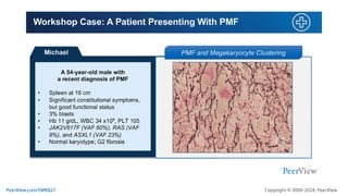 Mastering the Art of Myelofibrosis Care: Expert Guidance, Clinical ...