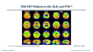 Navigating the New Era of Molecularly Defined Care in Alzheimer’s Disease: Applying Nuclear Medicine to Quantify Neuropathology and Improve Diagnostic Accuracy in the Earliest Stages of the AD Continuum