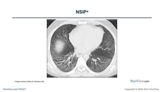 Improving Time to Diagnosis of Non-Cystic Fibrosis Bronchiectasis: The Importance of the Radiologist in Fulfilling Unmet Needs of Patients