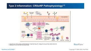 Treating With Precision in CRSwNP: Defining the Role of Targeted ...