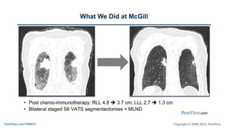 Realizing the Promise of Perioperative Immunotherapy in Resectable NSCLC: How to Modernize Best Practices Based on New Evidence and Better Multidisciplinary Alliances