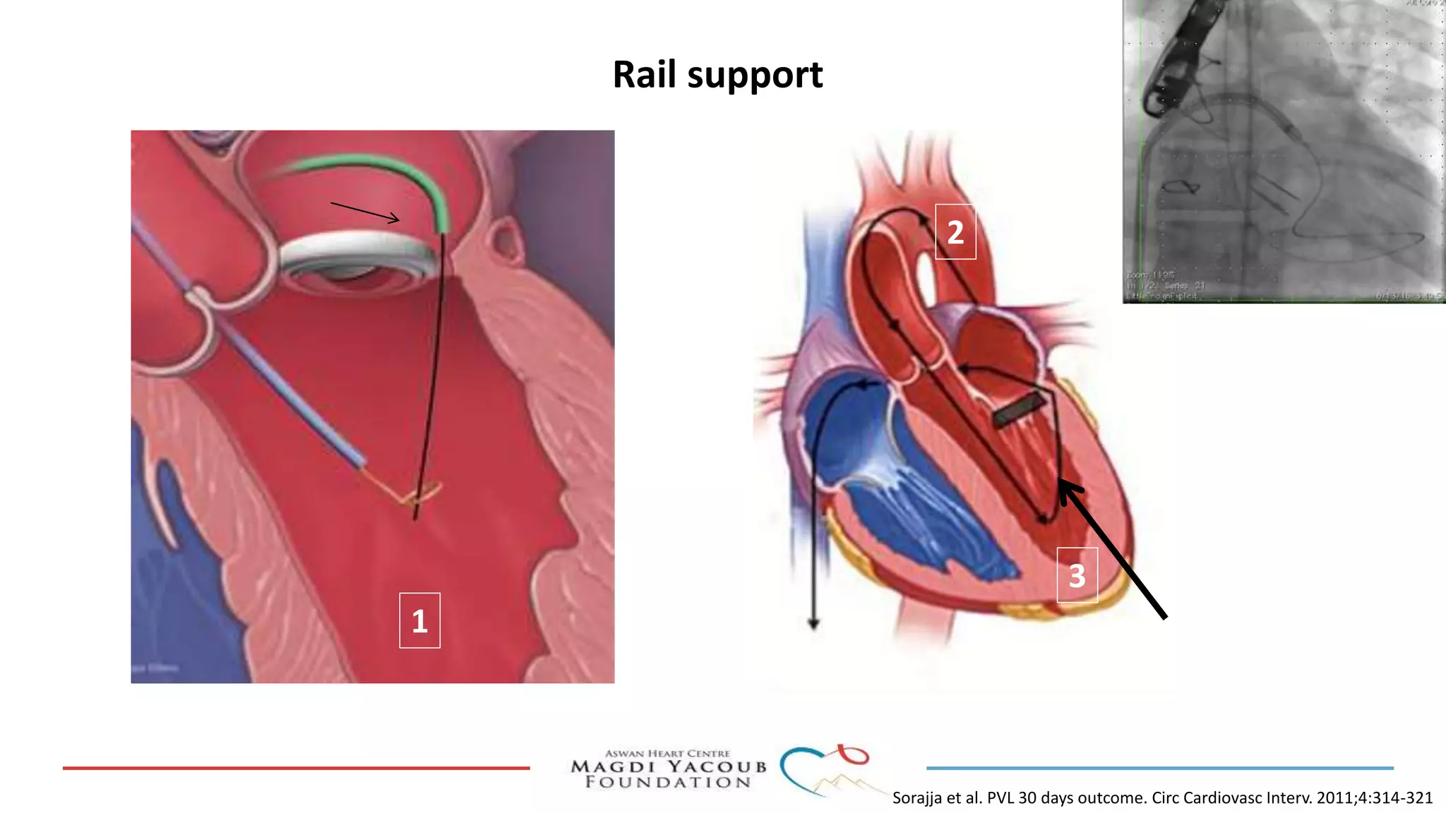 Percutanous PVL closure | PPT