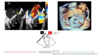 Percutanous PVL closure