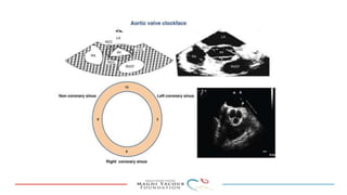 Percutanous PVL closure