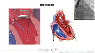 Percutanous PVL closure