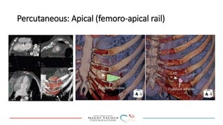 Percutanous PVL closure