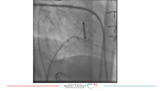 Percutanous PVL closure