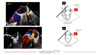 Percutanous PVL closure