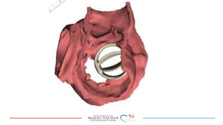 Percutanous PVL closure