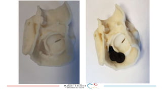 Percutanous PVL closure