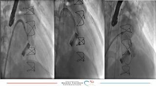 Percutanous PVL closure