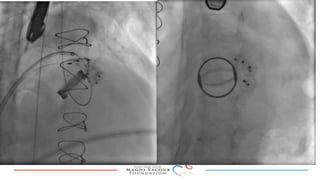 Percutanous PVL closure