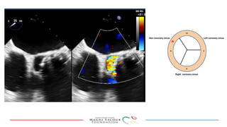 Percutanous PVL closure