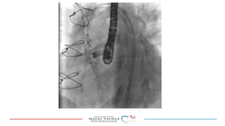 Percutanous PVL closure