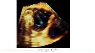 Percutanous PVL closure