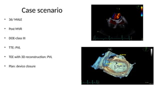 para valvular leak an overview sameer ppt.pptx