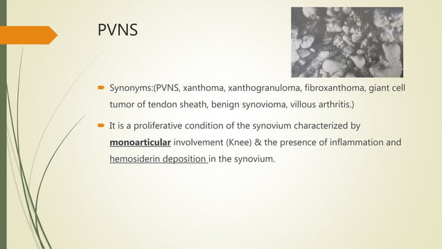 Pvns Rash PVNS,SYNOVIAL CHONDROMATOSIS & LOOSE BODIES | PPTX