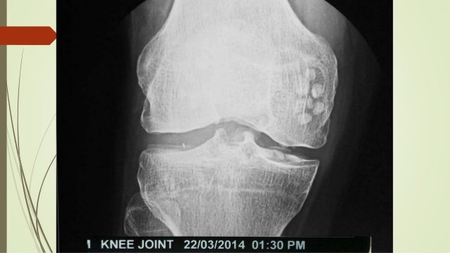 Pvns Synovial Chondromatosis Loose Bodies