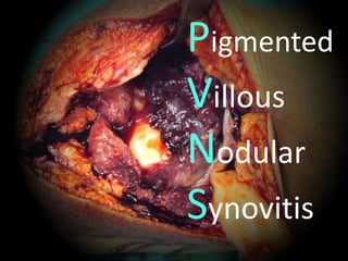 Pigmented
Villous
Nodular
Synovitis
 