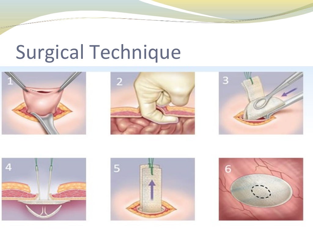 Proceed™ Ventral Patch vVentral Hernia Repair in Ambulatory Surgery.…