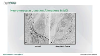 Complement-Mediated Attack of the Neuromuscular Junction in gMG: The C5 Inhibitors