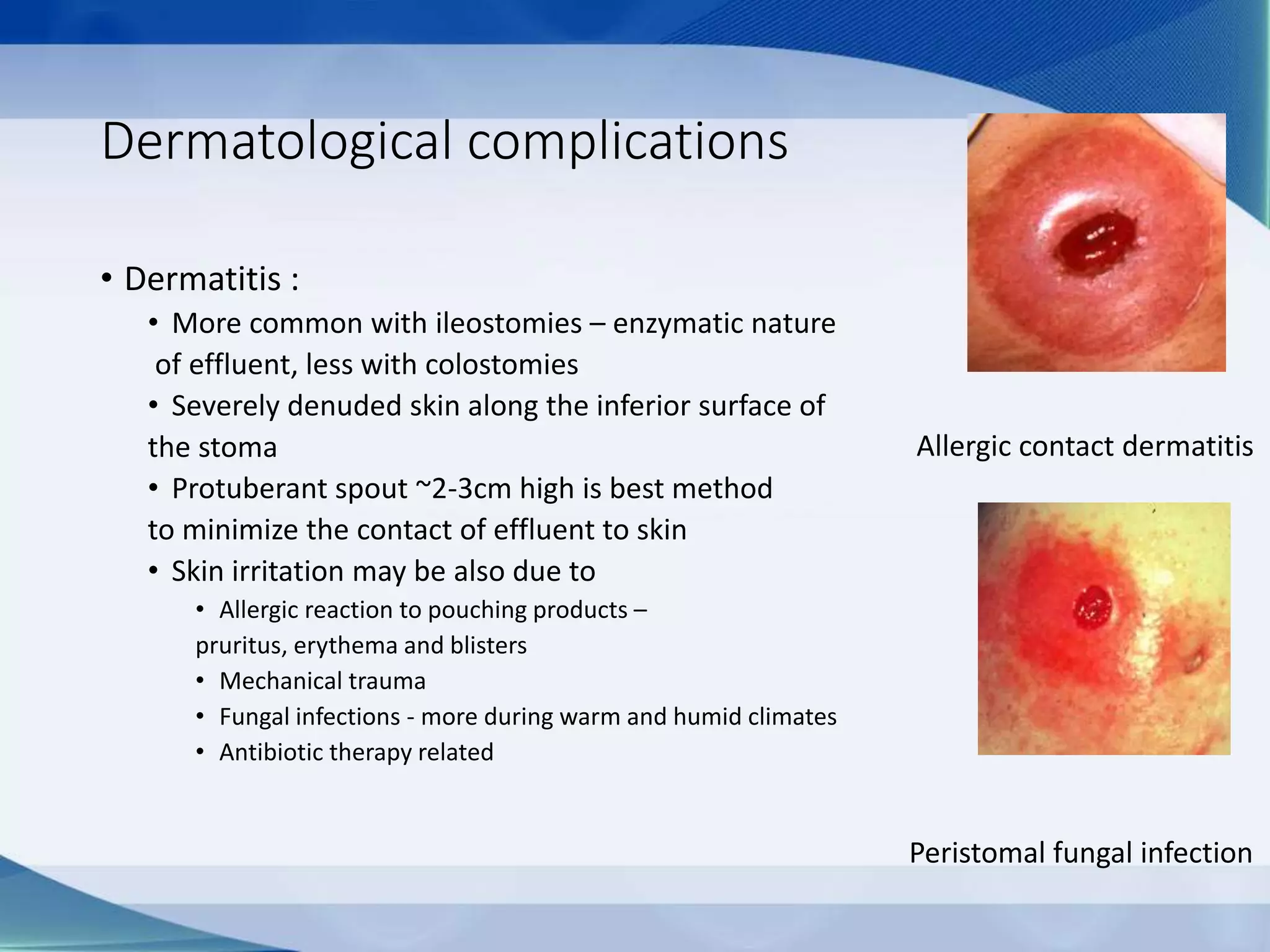 Dermatological complications
• Dermatitis :
• More common with ileostomies – enzymatic nature
of effluent, less with colostomies
• Severely denuded skin along the inferior surface of
the stoma
• Protuberant spout ~2-3cm high is best method
to minimize the contact of effluent to skin
• Skin irritation may be also due to
• Allergic reaction to pouching products –
pruritus, erythema and blisters
• Mechanical trauma
• Fungal infections - more during warm and humid climates
• Antibiotic therapy related
Allergic contact dermatitis
Peristomal fungal infection
 