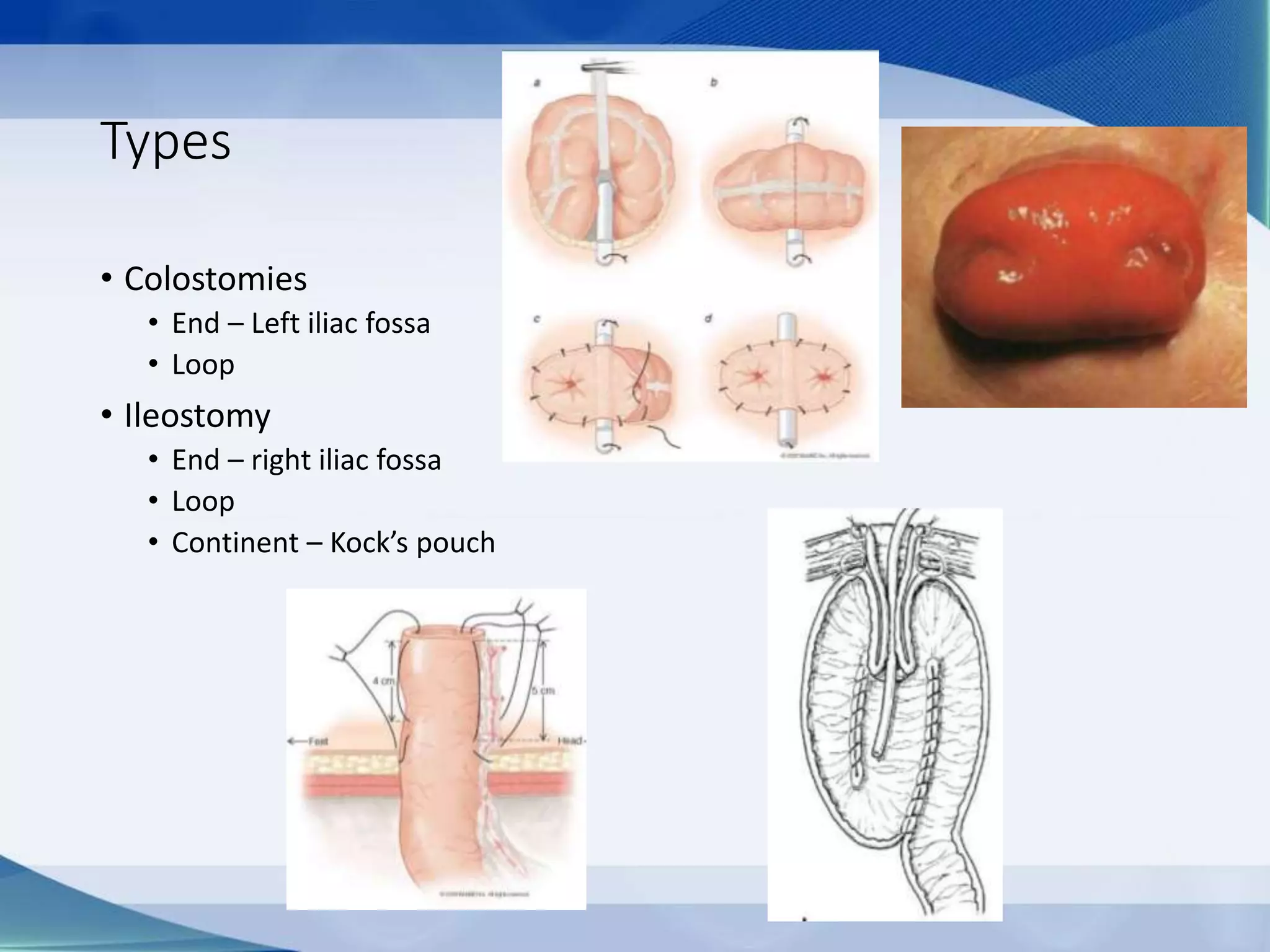 Types
• Colostomies
• End – Left iliac fossa
• Loop
• Ileostomy
• End – right iliac fossa
• Loop
• Continent – Kock’s pouch
 