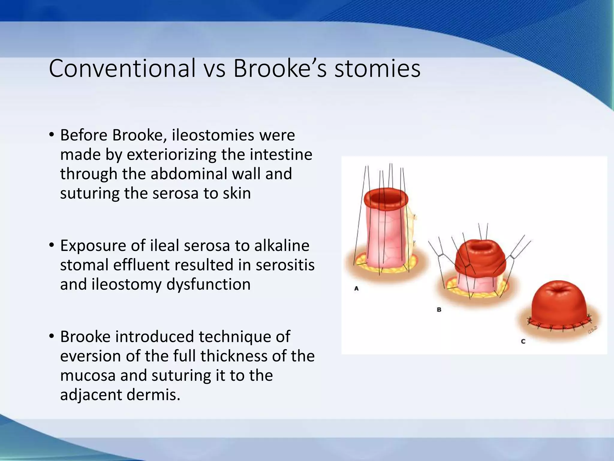 Conventional vs Brooke’s stomies
• Before Brooke, ileostomies were
made by exteriorizing the intestine
through the abdominal wall and
suturing the serosa to skin
• Exposure of ileal serosa to alkaline
stomal effluent resulted in serositis
and ileostomy dysfunction
• Brooke introduced technique of
eversion of the full thickness of the
mucosa and suturing it to the
adjacent dermis.
 