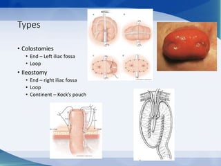 Stoma management | PPTX