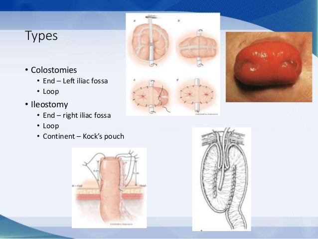 Stoma management