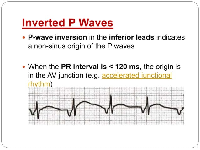 P wave (ECG) - Dr. Akif Baig | PPTX