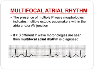 ECG Criteria of Right Atrial
Enlargement
 Right atrial enlargement produces a peaked P
wave (P pulmonale) with amplitude:...