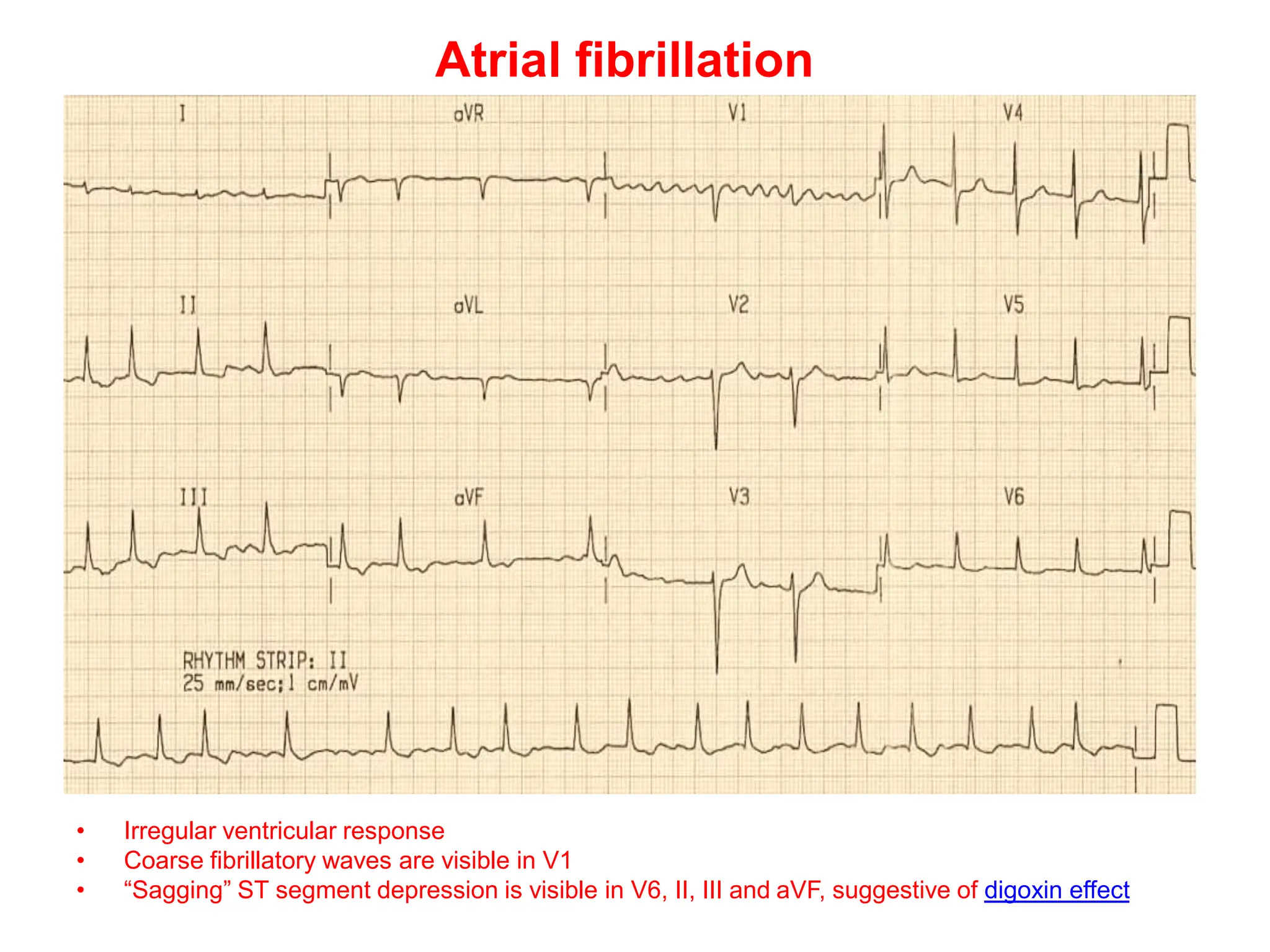 Atrial fibrillation
• Irregular ventricular response
• Coarse fibrillatory waves are visible in V1
• “Sagging” ST segment depression is visible in V6, II, III and aVF, suggestive of digoxin effect
 