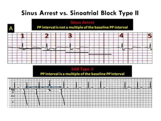 P WAVE IN ECG,ABNORMALITIES OF P WAVE IN ECG | PPTX