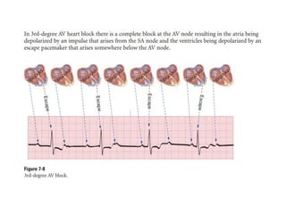 P WAVE IN ECG,ABNORMALITIES OF P WAVE IN ECG | PPTX