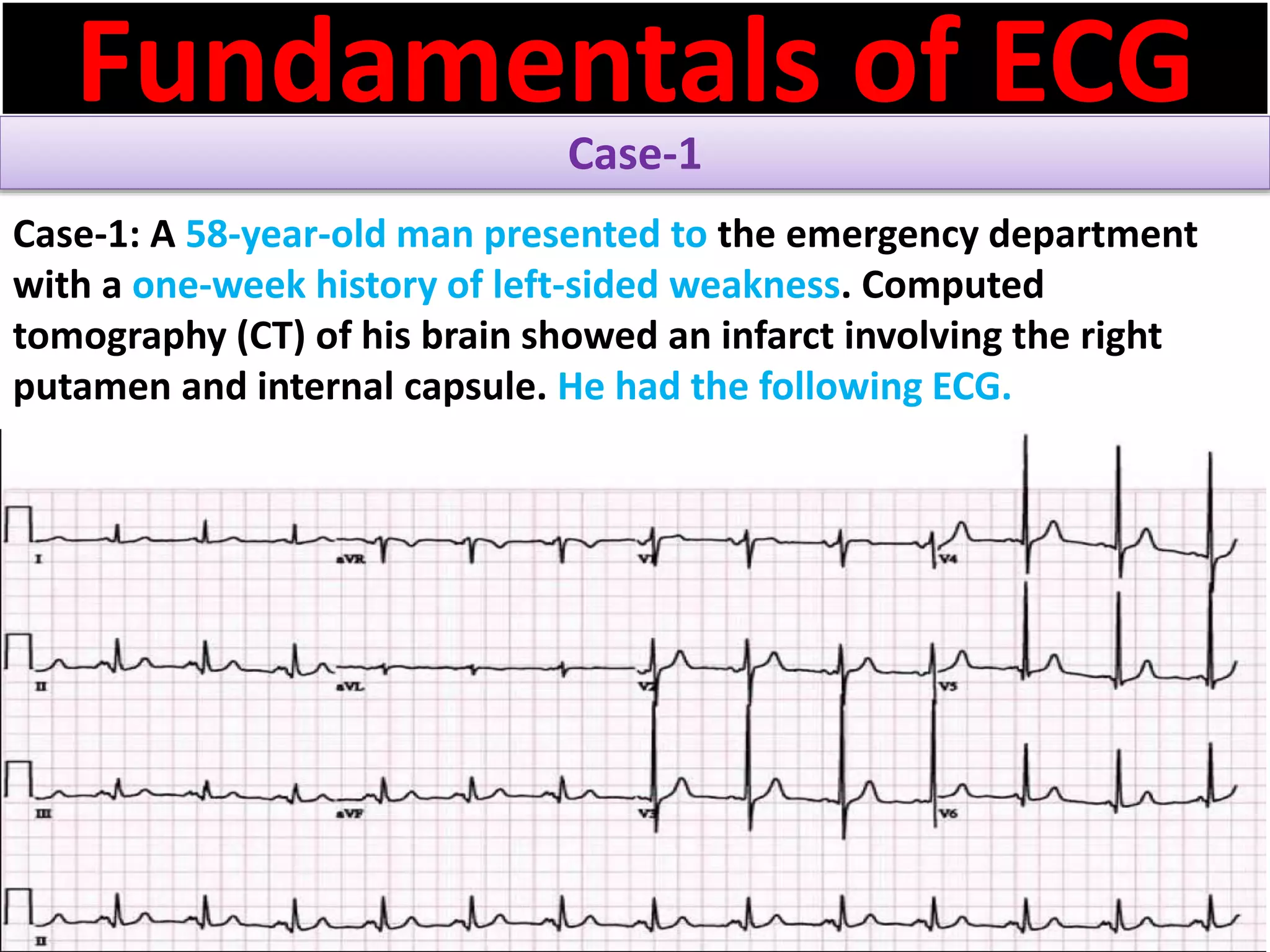 P wave abnormalities in ECG | PPSX
